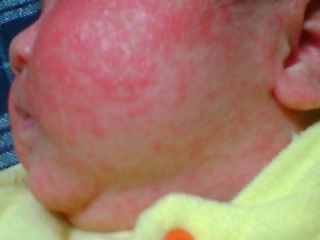 乳児湿疹のアロマ使用 L Esprit Herbe
